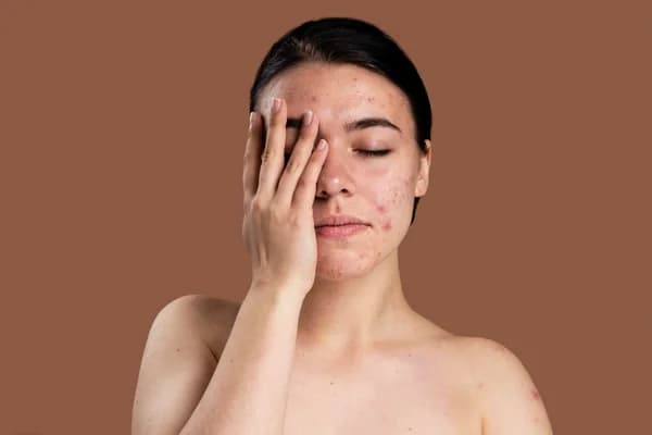 Acne control