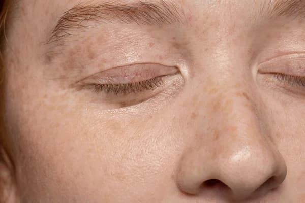 Pigmentation